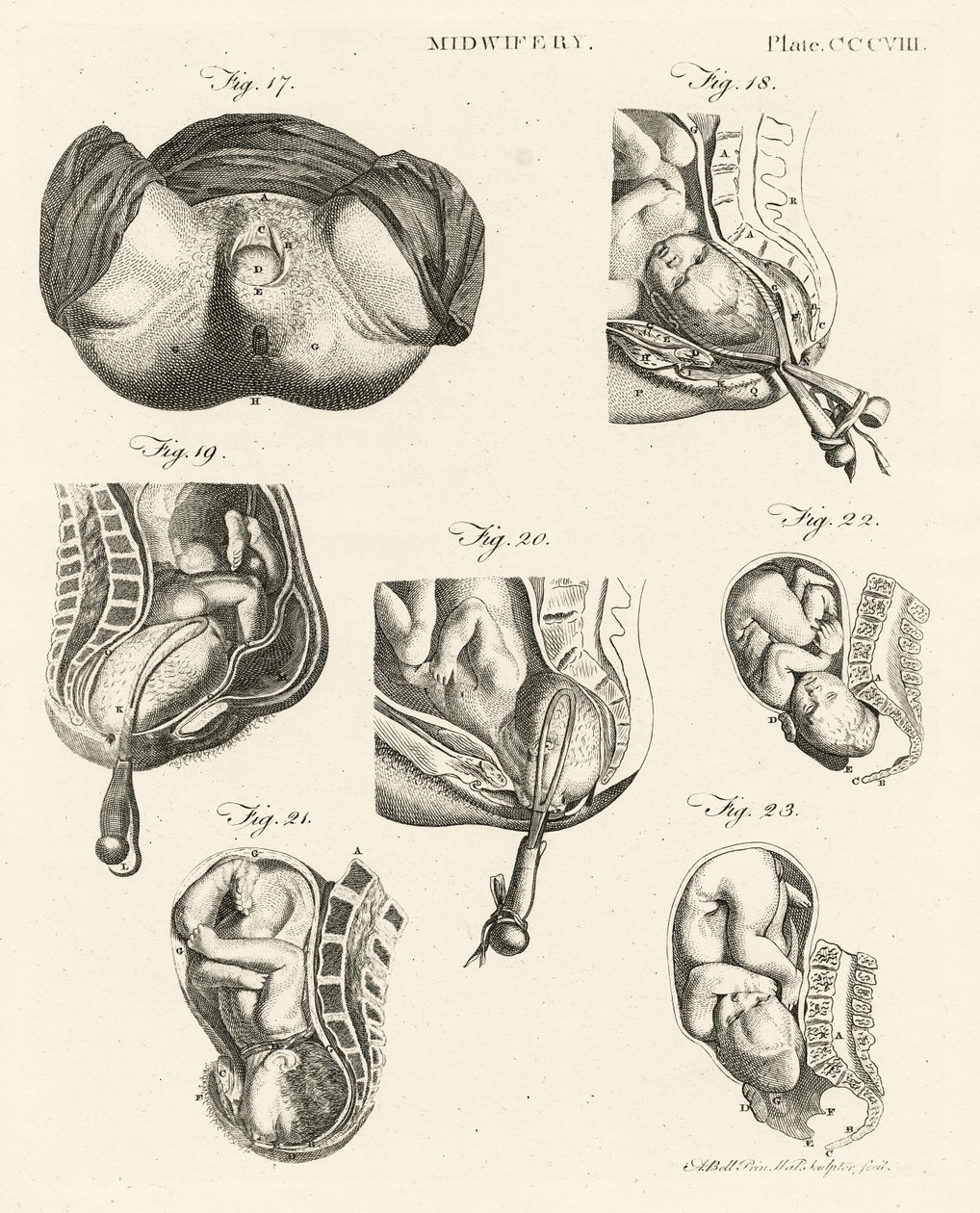 Szülésznő, illusztráció az "Encyclopedia Britannica"-ból, kiadva Edinburgh-ban, 1798 (rézmetszet) alkotó: Alexander Bell