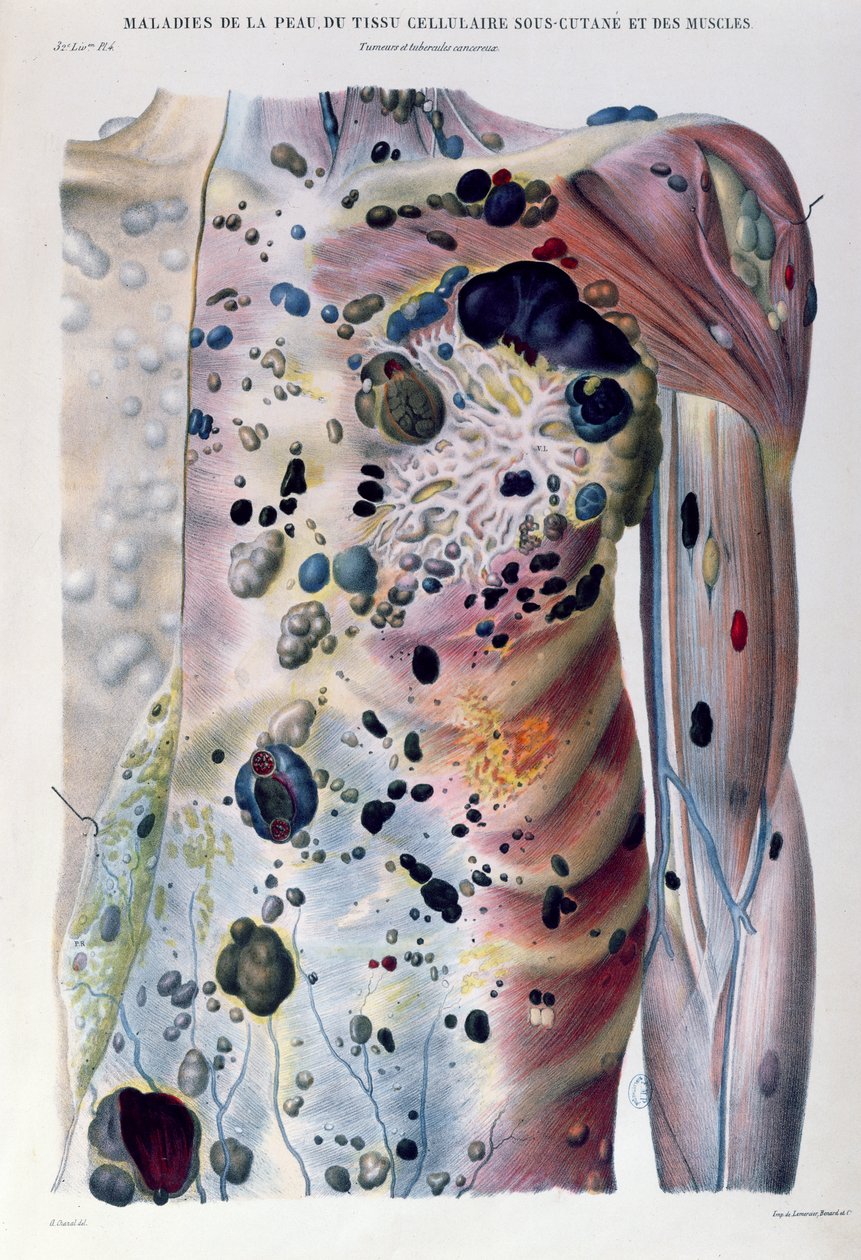 Daganatok és rákos gumók, Jean Cruveilhier (1791-1874) „Anatomie Pathologique du Corps Humain” című művéből, 1828-42 alkotó: Antoine Chazal