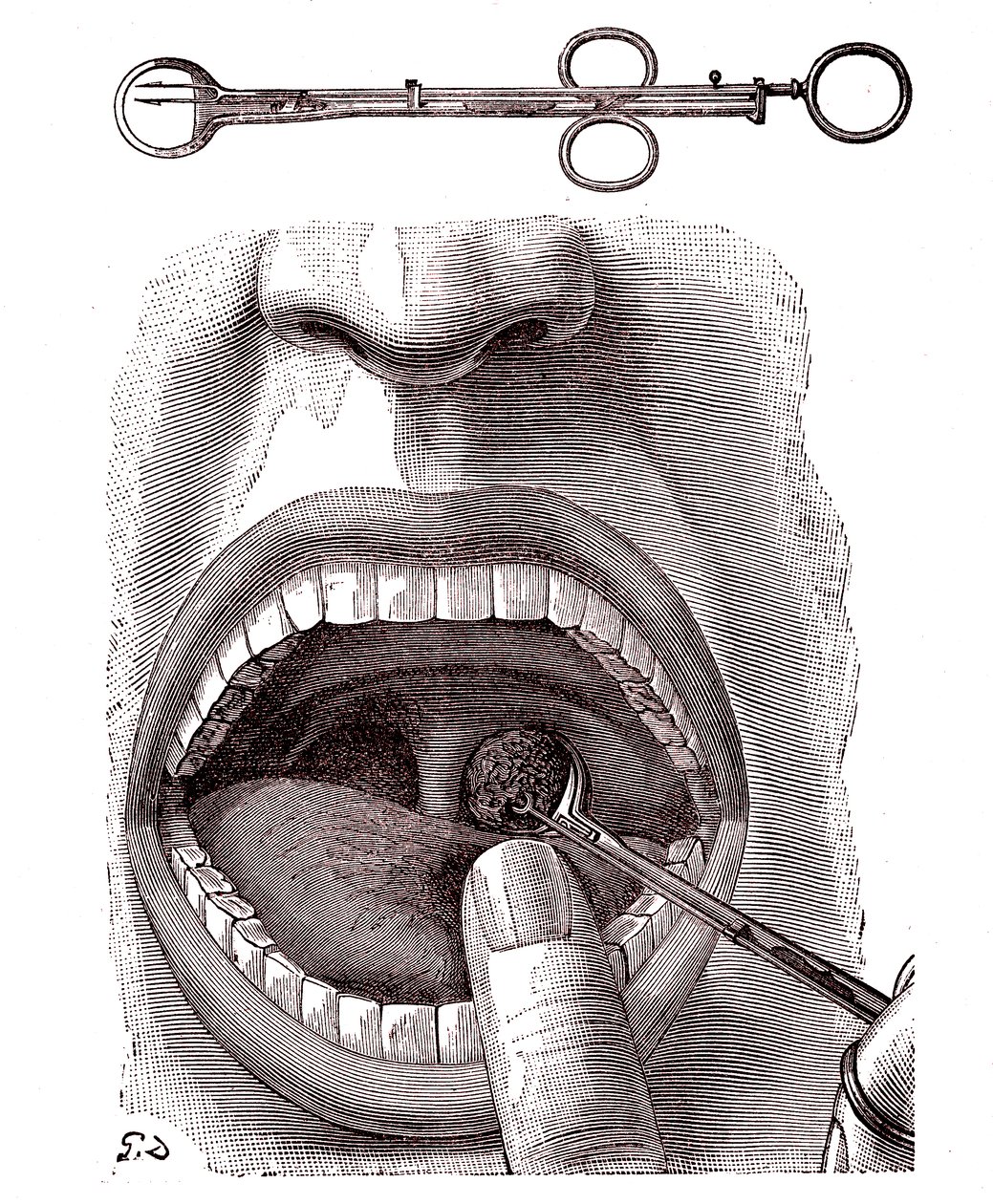 Tonsillectomy. 1887 (engraving) alkotó: French School