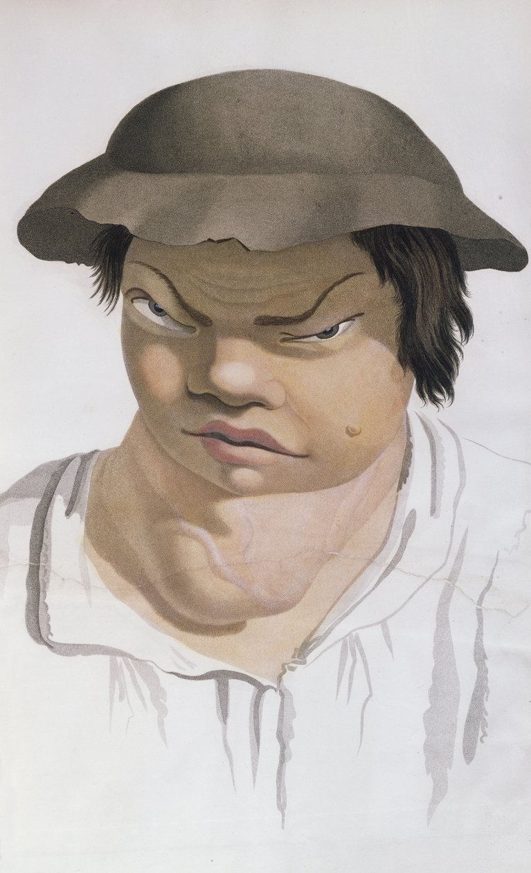 Endemikus Scrofula, illusztráció Jean Louis Alibert báró (1768-1837) könyvéből alkotó: Salvadore Tresca
