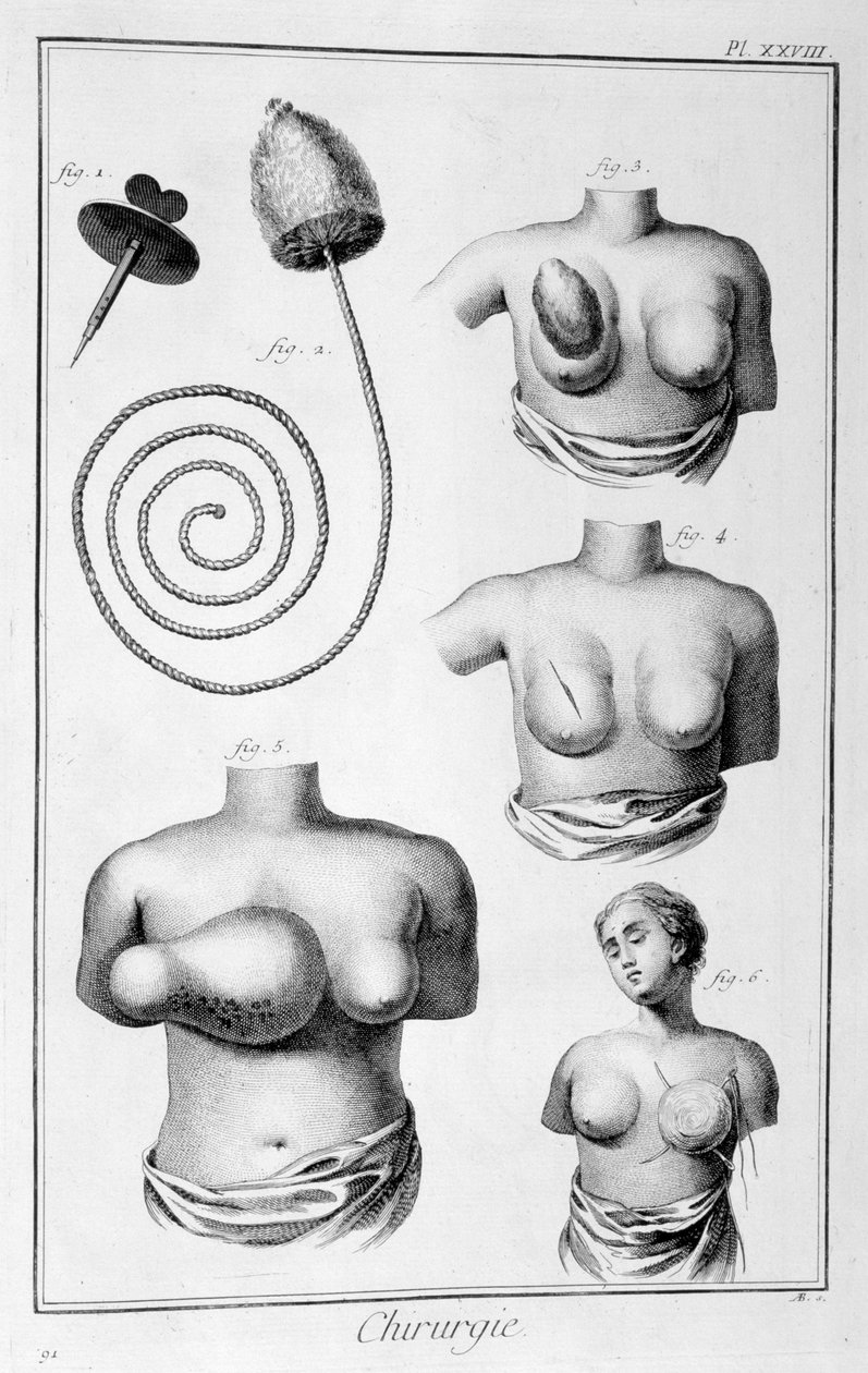 Mellsebészet, 1751-1777 alkotó: Unbekannt