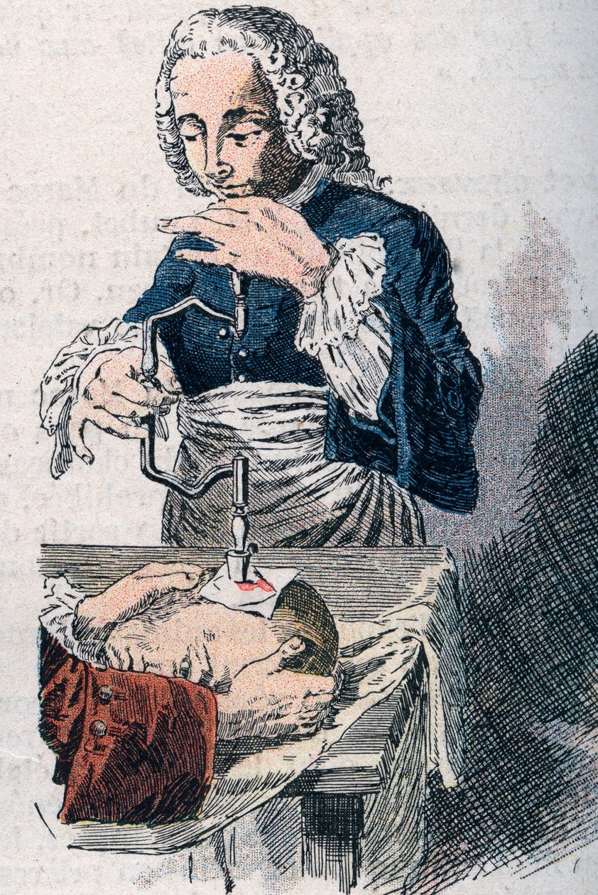 A Trepanáció. 18. századi nyomtatvány. alkotó: Unknown artist